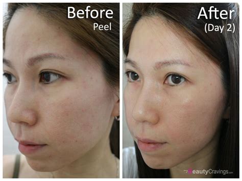 how many glycolic peels to see results|Glycolic Acid Peel: 10 Things to Know Before You Get .